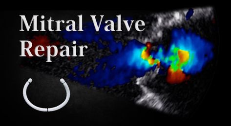 By Mustafa Ahmed MD and David McGiffin MD What is Mitral Valve Repair Surgery? When the mitral valve is severely diseased it can lead to [...]Read More Mitral Valve Regurgitation, Heart Surgery Recovery, Heart Valve, Common Diseases, Mitral Valve, Heart Valves, Open Heart Surgery, Arm Exercises, Heart Surgery