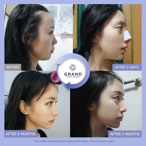 Jaw Reduction Surgery, Nose Plastic Surgery, Double Jaw Surgery, Nose Surgery Rhinoplasty, Change Appearance, Plastic Surgery Fails, Japanese Translation, Hooked Nose, Face Transformation