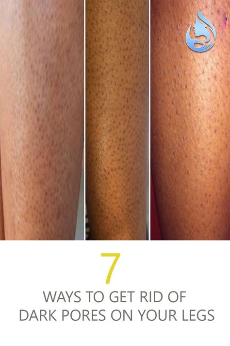 Those annoying little black dots on your legs? They’re just darkened pores and the most likely cause of those is excess oil, improper shaving, ingrown hairs, dirt, and bacteria. If you’re ready this, that means you’ve had ENOUGH of those dark pores on your legs and you would like to do something about it. Fret no more, because these 7 tips will get your legs super smooth and dark pore free! So here are 7 ways to get rid of dark pores on your legs. Best Shave, Smooth Legs, Ingrown Hairs, Best Oils, Had Enough, Ingrown Hair, Black Dots, After Shave, Do Something