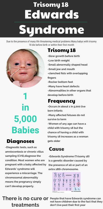 Fetal Ultrasound, Edwards Syndrome, Go Study, Sonography Student, Heart Defect, Genetic Disorders, Medical Problems, Ultrasound, Genetic