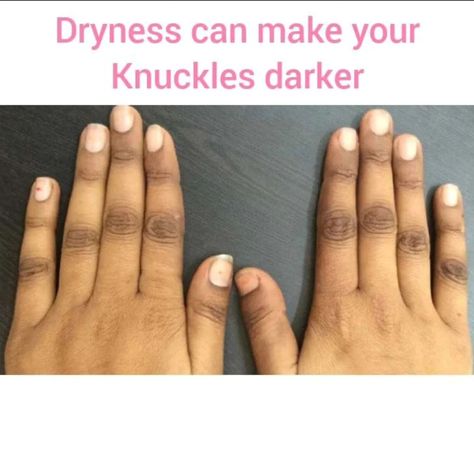 Although the primary causes of dark knuckles can be genetic, drug reactions, medical conditions, or harsh skin-whitening products, dryness can also be a contributing factor. You might wonder why your knuckles are darker even without these causes—dryness could be the culprit! Constant handwashing and exposure to harsh detergents dry out the skin, making the knuckles hard and dark over time. If you're looking to get rid of or prevent dark knuckles, exfoliation and moisturization are crucial. ... Dark Knuckles, Whitening Products, Genetic, Medical Conditions, Conditioner, Medical, Wonder, Make It Yourself, Canning