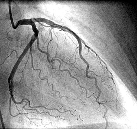 Predicting Heart Attacks with New, Noninvasive Imaging Angiography Heart, Cardiology Aesthetic, Cardiovascular Technology, Coronary Angiography, Cardiology Study, Cardiac Cath, Sore Calves, Heart Catheterization, Heart Arteries