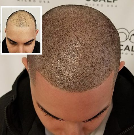 Head Tattoo Hair, Hair Pigmentation, Hairline Tattoos, Scalp Tattoo, Tattoo Hair, Scalp Micropigmentation, Head Tattoo, Tattoo Prices, Bald Hair