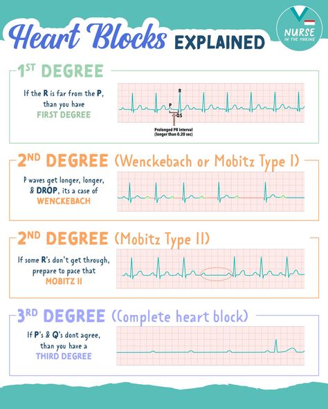 A heart block of any degree is a... - Nurse In The Making Heart Blocks Made Easy Nursing, Heart Blocks Nursing, Ekg Interpretation Made Easy, Ekg Leads, Nurse In The Making, Emt Study, Ekg Interpretation, Nurse Teaching, Pr Interval