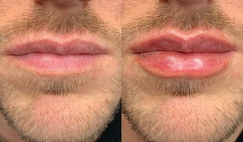 Serge A. Steenen, MD DDS (@dr_steenen) posted on Instagram: “Male lips by doctor Serge A. Steenen, MD DDS . 🇳🇱 . #masculine #masculinity #malemodel #man #lipfillers #lip #lips #beauty #faceland…” • Mar 13, 2020 at 5:21pm UTC Mens Lip Filler, Mens Lips, Man Lips, Men Lips, Male Lips, Filler Ideas, Female Lips, People Reference, Facial Contouring