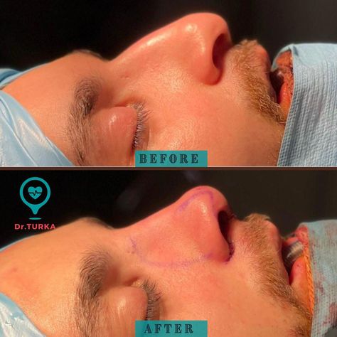 Mens Nose Job, Men Nose Job, Men Rhinoplasty, Male Nose Job, Male Rhinoplasty, Male Nose, Nose Structure, Smooth Nose, Nose Types