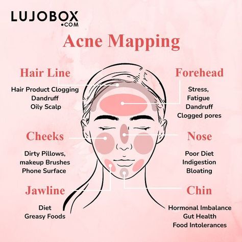 Here's a Face Map that might helpIf you are noticing concentrated breakouts on your facethere's a strong reason something is causing itKnowing the cause will help make the needed changes to control acne more effectively and avoid them in the futureacnemapping acnetreatment causeofacne acnepositivity acneawareness acne pimples blackheads skincare skincaretips skincareaddict skincare loveyourself confidence monthlysubscription beautybox lujobox lujoboxbeauty Reasons For Pimples, Acne Map, Face Map, Acne Reasons, Pimple Causes, Blind Pimple, Pimples Under The Skin, Pimples On Face, Face Mapping