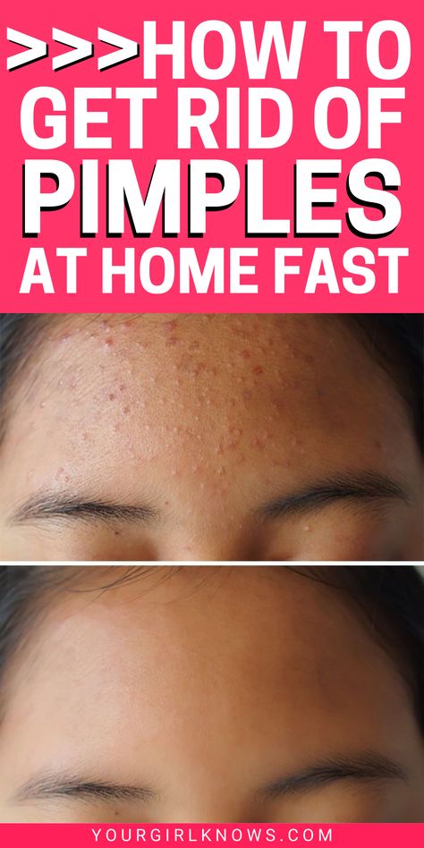 Get Rid Of Pimples On The Nose You Will Need Get Rid Of Acne Fast, Rid Of Acne Overnight, Get Rid Of Acne Overnight, Face Mapping Acne, Blind Pimple, Get Rid Of Pimples, Rid Of Pimples, Pimples Under The Skin, Bad Acne