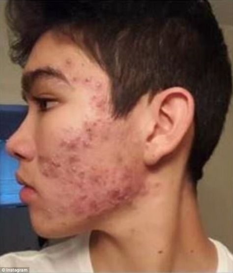 Teenage boy CLEARED severe acne with an $8 moisturizer Budget Skincare, Acne Men, Comedonal Acne, Cystic Acne Remedies, Acne Routine, Teenage Acne, Remedies For Acne, Acne Moisturizer, Bad Acne