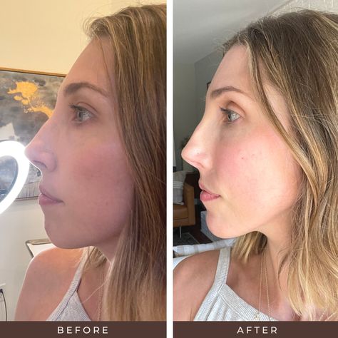 I Tried Chin Filler & Here’s What Happened – Mamas Got Plans Chin Before And After Filler, Chin Jaw Filler, Chin Augmentation Before And After, Filler For Jowls, Chin And Jawline Fillers, Chin Injection Before And After, Chin Fillers Before After Round Face, Chin Implant Before And After, Chin Botox Before And After