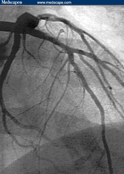 Normal Coronary Angiogram | Coronary angiogram demonstrating a wide open proximal left anterior ... Coronary Angiography, Cardiac Cath, Coronary Arteries, Chasing Dreams, Cardiology, Nursing, Health Care, Medical, Log In