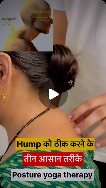 How To Treat Neck Hump, Exercise To Reduce Neck Hump, How To Reduce Neck Hump, Hairstyles To Hide Neck Hump, Hump Neck Exercise, Exercise For Neck Hump, Remove Neck Hump, Neck Hump Correction, Neck Posture Correction