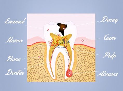 Absessed Tooth, Abcessed Tooth, Facial Swelling, Abscess Tooth, Tooth Pain Remedies, Severe Tooth Pain, Wisdom Teeth Pain, Tooth Pain Relief, Tooth Nerve