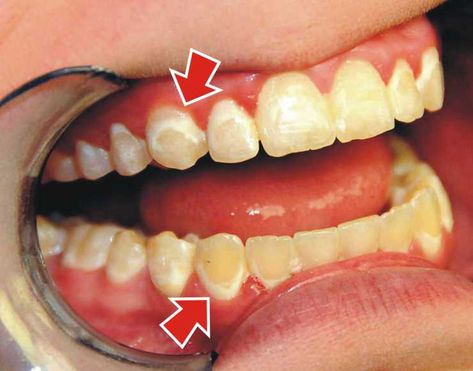 Teeth After Braces, After Braces, Plaque Teeth, Braces Tips, Braces Off, Discolored Teeth, Teeth Whitening Toothpaste, Brace Face, Charcoal Teeth Whitening