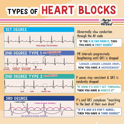 🫀 TYPES of HEART BLOCKS 🫀 1st degree= prolonged PR interval, that's all! 2nd degree type ONE (aka Wenckebach)= PR intervals progressively lengthen until the QRS is dropped completely- hence the poem "longer,longer, longer DROP" 2nd degree type TWO (aka Mobitz II)= PR intervals stay the same and a QRS is just randomly dropped, no progressive lengthening 3rd degree= P and QRS complexes are marching to the beat of their own drum Types Of Heart, Respiratory Therapy Student, Medical Terminology Study, Np School, Paramedic School, Pr Interval, Nursing Information, Nurse Study Notes, Heart Blocks