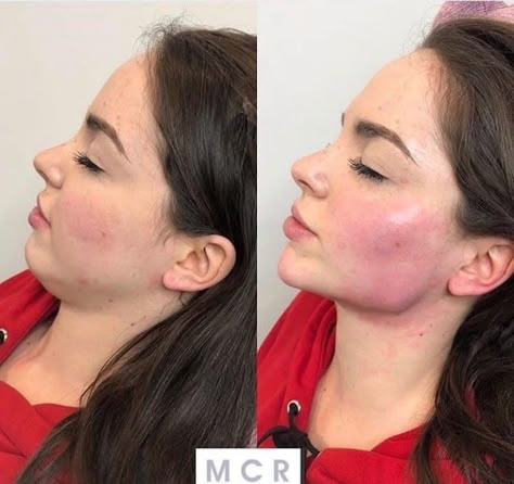 Face Plastic Surgery, Rhinoplasty Nose Jobs, Face Fillers, Face Surgery, Cheek Fillers, Beauty Procedures, Facial Contouring, Facial Fillers, Bold Makeup Looks