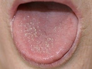 Transient lingual papillitis | DermNet NZ Lie Bumps On Tongue, Bumps On Tongue, Tongue Sores, Lymph Glands, Mouth Rinse, Tongue Health, Abs Workout For Women, Health Habits, Chronic Inflammation