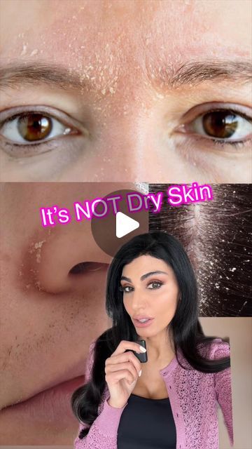 Dr. Azadeh Shirazi on Instagram: "It’s not dry skin! It’s actually from build up of yeast that feed on excess oil and cause a reaction with redness, dry flaky skin around the nose, mouth, and in the eyebrows. Mix SootheHC @azimdskincare with Clotrimazole cream in a 1:1 ratio and apply it to the dry flakes 2-3x a day for 1-2 weeks to clear it.  It’s going to want to come back so prevent flares by washing with medicated shampoos like @headandshoulders with Zinc.  If you still have trouble call me 📞 ⁣ Photo Consults: link in Bio 👆⁣ To see me as a patient⁣ 📲 or text: (858)943-2171⁣ 📩  info@lajollalaserderm.com⁣ ⁣ ⁣ ⁣ ⁣ ⁣ ⁣ ⁣ ⁣ ⁣ ⁣ ⁣ ⁣ ⁣ ⁣ ⁣ ⁣ ⁣ ⁣ ⁣ ⁣ ⁣ ⁣ ⁣ The content of this page is for educational and informational purposes and does not constitute formal medical advice. #seborrheicdermat Flaky Skin On Face, Dry Peeling Skin, Super Dry Skin, Facial For Dry Skin, Scale Skin, Dry Skin Problem, Flaking Skin, Healing Dry Skin, Dry Flaky Skin