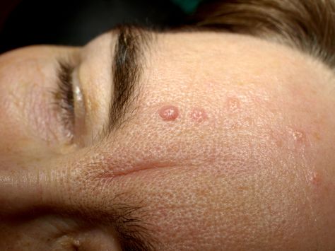 Seborrhoeic keratosis is a common, harmless skin growth. It can also be known as basal cell papilloma, senile wart, brown wart, age spots or barnacle. Sebaceous Hyperplasia, Seborrheic Keratosis, Warts On Face, Remove Skin Tags Naturally, Rare Genetic Disorders, Dry Oily Skin, Basal Cell, Skin Growths, Bumpy Skin