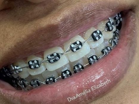 Black Braces No Power Chain, Metal Braces Colors, Braces Colors Ideas Dark Skin, Brackets Aesthetic, Dental Braces Colors, Braces Colors Combinations, Green Braces, Jewelry Teeth, Braces Black