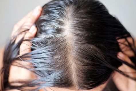 My wife was diagnosed her with telogen effluvium, which is essentially temporary hair loss caused by extreme stress on the body. The post If Your Hair Is Falling Out, You’re In Good Company appeared first on Scary Mommy. Androgenetic Alopecia, Hair Growth Cycle, New Hair Growth, Lost Hair, Normal Hair, Hair Transplant, Treated Hair, Hair Health, About Hair