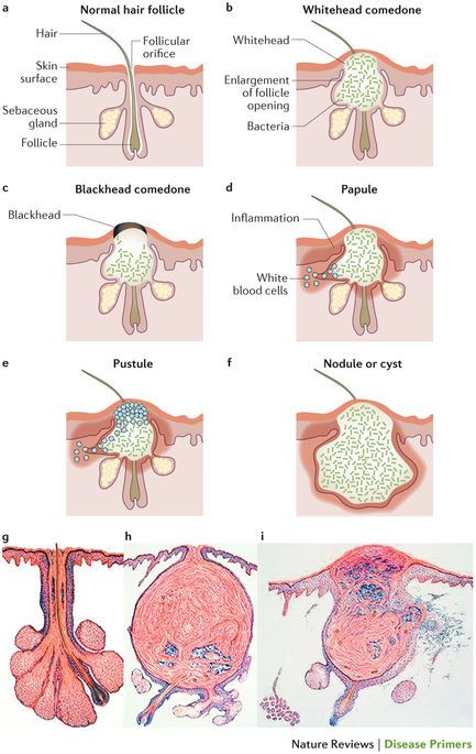 Figure 1 Skin Anatomy, Medical Esthetician, Blind Pimple, Integumentary System, Pimples Under The Skin, Skin Facts, Skin Moles, Best Acne Products, Mary Kay Skin Care