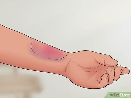 How to Tell if Your Wrist Is Sprained: 7 Steps (with Pictures) Sprained Wrist Pictures, How To Heal A Sprained Wrist, How To Wrap Your Wrist, How To Wrap A Sprained Wrist, Wrist Sprain, Swollen Hands, Sprained Wrist, Hairline Fracture, Body Inflammation