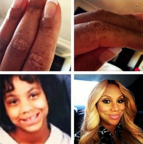 Tamar Braxton Opens Up About Abuse, Posts Photos of Vitiligo,Since being a standout sister… Medical Textbooks, Skin Grafting, Tamar Braxton, Diva Style, Toni Braxton, White Patches, Skin Disorders, Skin Diseases, Family Values