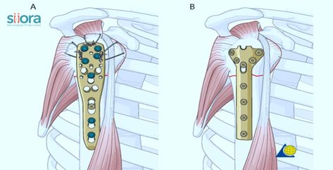 orthopedic implant manufacturers Humerus Fracture, The Details, Surgery, Acting, India, How To Wear, Quick Saves