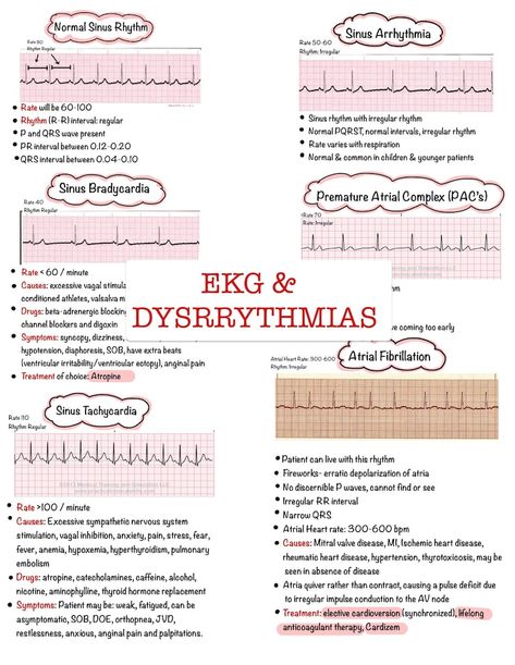 Basic EKG Dysrhythmias & Interpretation Nursing Notes 6 PAGES Digital Download PDF - Etsy Ekg Study Notes, Heart Blocks Nursing, Nursing Dysrhythmias, Junctional Rhythm, Heart Conduction, Ekg Tech, Ekg Technician, Ekg Rhythms, Nursing Management