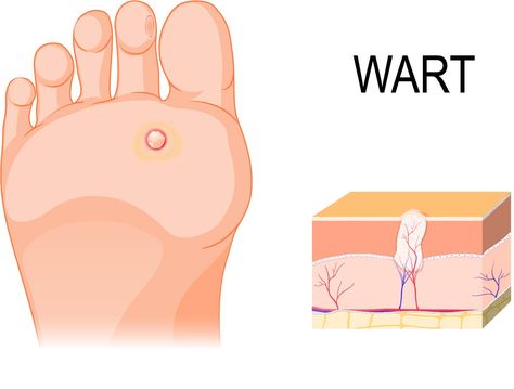 Warts are no fun! Use vinegar to remove them Uses For Apple Cider, Plantar Warts, Strawberry Legs, Get Rid Of Warts, Apple Cider Benefits, Tea Tree Essential Oil, Cotton Ball, Tree Oil, Cider Vinegar