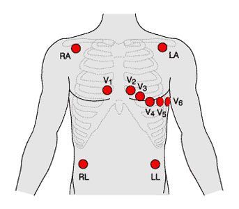 12 Lead ECG placement. | Medic School | Pinterest | Posts and Html Ecg Placement, Telemetry Nursing, Emt Study, Nursing Board, Emt Paramedic, Cardiac Nursing, Critical Care Nursing, Nursing School Studying, Nursing School Tips