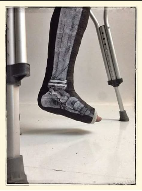 My artist buddy painted his daughters broken leg x-ray onto her cast. Pins and all. - Imgur Walking Cast, Cast Decoration, Broken Foot, Ankle Surgery, Broken Ankle, Leg Cast, Cast Art, Rock Lee, Broken Leg