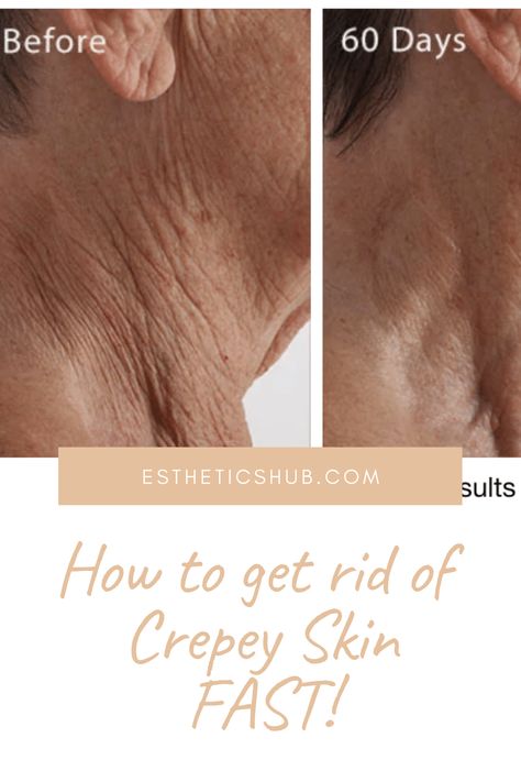 If you suffer from Crepey skin on your neck, arms or legs, you need to read this post! Crepey Neck Skin Remedies Diy, How To Fix Crepey Skin, How To Get Rid Of Crepey Skin On Arms, Crepe Skin Remedy How To Get Rid, Creepy Skin On Arms, Crepey Neck, Best Lotion For Crepey Skin, Creepy Skin How To Get Rid Of, Crepe Neck Skin Remedy