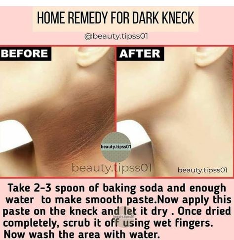 Dark Neck Remedies, Dark Neck, Beginner Skin Care Routine, Face Skin Care Routine, Diy Skin Care Routine, Serious Skin Care, Good Skin Tips, Healthy Skin Tips, Skin Care Remedies