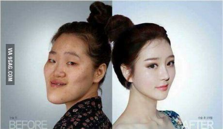 South Korean Plastic Surgery, Korean Surgery, Double Jaw Surgery, V Line Surgery, Plastic Surgery Korea, Korean Plastic Surgery, Face Surgery, Celebs Without Makeup, Jaw Surgery