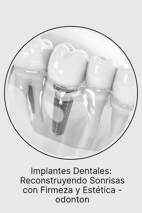 Los implantes dentales han revolucionado la odontología, brindando una solución perdurable y estéticamente agradable para la pérdida de dientes. # implantes dentales # implantes dentales publicidad # implantes dentales antes y después Branding