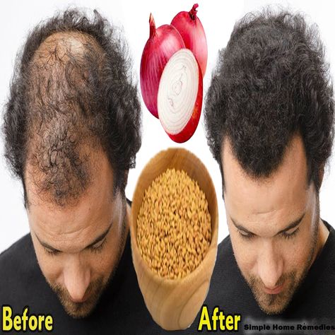 Simple Home Remedies - Make onion with rice water solution for faster hair growth and stop hair fall Onion Hair Growth, Faster Hair Growth, Onion For Hair, Tennessee Travel, Rice Water, Water Solutions, Fast Hairstyles, Hair Growth Faster, Simple Home