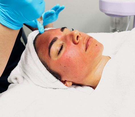 Prp Facial, Plasma Facial, Microneedling With Prp, Spa Images, Vampire Facial, Aesthetic Dermatology, Micro Needling, Hydra Facial, Aesthetic Clinic