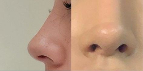 Upturned Nose, Rhinoplasty Nose Jobs, Job Inspiration, Straight Nose, Pretty Nose, Perfect Nose, Small Nose, Nose Surgery, Button Nose