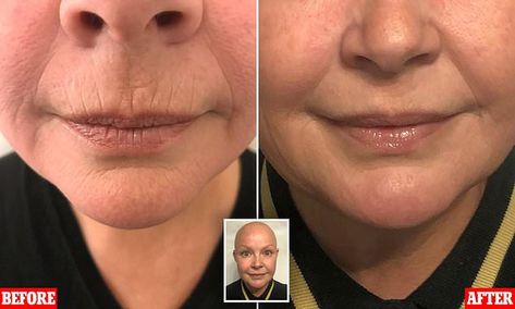 Gail Porter gets 'natural' fillers to get rid of lines on top lip | Daily Mail Online Lip Line Filler, Gail Porter, Upper Lip Wrinkles, Best Dark Spot Remover, Smokers Lines, Best Smoker, Botox Lips, Aesthetic Dermatology, Wrinkle Filler