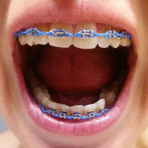 If you're unfamiliar with the process of getting braces, it will be beneficial to take a few moments to learn the overview of the process and what you can expect. Black Power Chain Braces, Chain Braces, Light Blue Braces, Power Chain Braces, Blue Braces, Braces Color Wheel, White Braces, Power Chain, Braces Cost