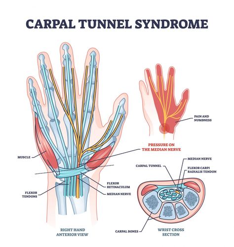 Pregnancy and Carpal Tunnel Syndrome - Giggle Magazine Carpal Tunnel Anatomy, Carpel Tunnel Syndrome, Muscle Diagram, Physical Therapy Student, Median Nerve, Computer Vector, Muscular System, Hand Pain, Muscle Anatomy