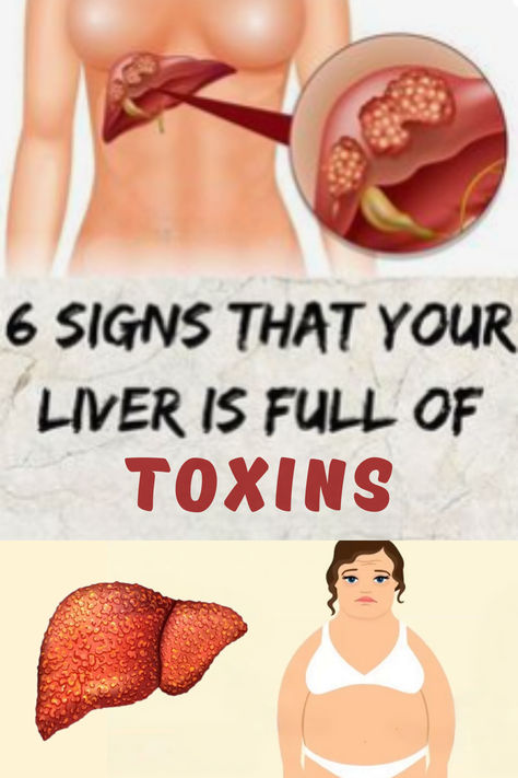 Signs that the liver may be overworked include persistent fatigue, abdominal bloating, pale stools, and yellowing of the skin and eyes. #overworkedliver #liver #liverhealth #healthyliver Overworked Liver, Liver Care, Liver Issues, Homemade Detox Drinks, Abdominal Discomfort, Homemade Detox, Naturopathic Doctor, Healthy Blood Sugar Levels, Healthy Liver