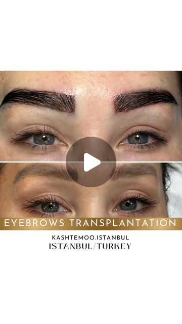 samira partabi on Instagram‎: "CHERRY ON THE TOP 🍒❤️
Contact us for free consultations for eyebrow transplant 
📱+905551505050 
.
.
.
.
.
#EYEBROWTRANSPLANT
#EYEBROWTRANSPLANTISTANBUL
#KAŞEKİMİ 
#EyebrowTransplant #BrowGameStrong #BeautyEnhancement
#EyebrowTransplant #DoctorLife #AestheticMedicine
‎#کاشت_ابرو
‎#کاشت_ابرو_استانبول
#EYEBROWTRANSPLANT
#EYEBROWTRANSPLANTISTANBUL
#KAŞEKİMİ 
#KASHTEMOOISTANBUL
#KASHTEMOO_ISTANBUL
#KAŞEKİMİistanbul 
#BrowGoals #BeautyTransformation”
#EyebrowTransplant #BrowGoals #BeautyTransformation"‎ Eyebrow Transplant, Aesthetic Medicine, On The Top, Contact Us, Eyebrows, Istanbul, The Top, Cherry, For Free