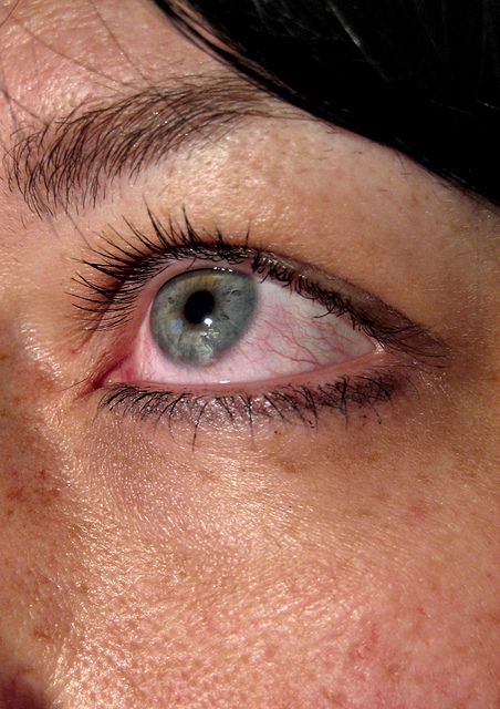 Allergy Season, Eye Damage, Homemade Laundry, Seasonal Allergies, Tired Eyes, Dry Eyes, Eye Health, How To Take, Eye Care