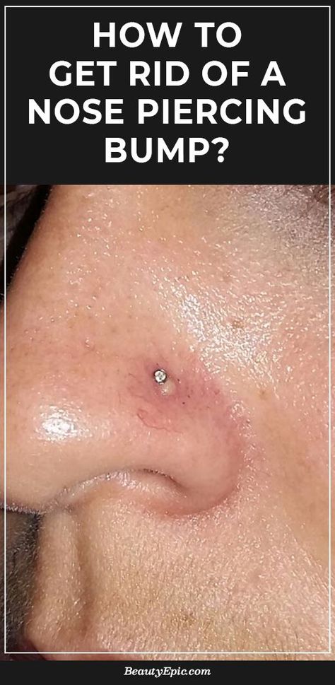 After piercing the nose, a bump appears at the site. This occurs often because of infection or allergic reactions but it can be healed. Get Rid Of Nose Bump, Pimple Under Nose, Nose Ring Bump How To Get Rid Of, How To Get Rid Of A Bump On Your Nose, Getting Nose Pierced, Nose Ring Bump, Bump On Piercing How To Get Rid Of, Different Nose Piercings, Nose Infection