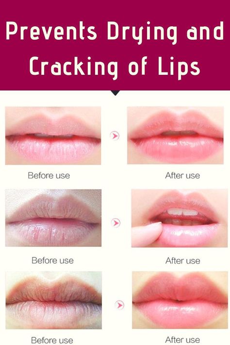 Here are simple and effective home remedies for pink lips which will surely turn your dark lips so soft and shiny and will make you smile more and more. Remedies For Dark Lips, Home Remedies For Pimples, Banana Face Mask, Tumeric Face Mask, At Home Face Mask, Oil For Dry Skin, Face Scrub Homemade, Pigmented Lips, Skin Care Collection