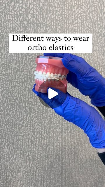 Different ways to wear your orthodontic elastics and how they help to move your teeth Braces With Rubber Bands, Fix Overbite, Orthodontics Teeth, Braces Rubber Bands, Braces Bands, Braces Elastics, Diy Elastic, Straight Teeth, Fix You