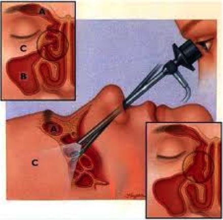 This outpatient minimally invasive sinus surgery does not require any incisions on the face, yet efficiently and effectively targets diseased areas within the nose and sinuses. None of the healthy tissues within the sinus cavities are disturbed, but rather only the diseased or blocked areas are widely opened to allow proper drainage of the sinus … Continue reading Functional Endoscopic Sinus Surgery (FESS) → Endoscopy Procedure, Nasal Polyps, Blocked Sinuses, Sinus Remedies, Paranasal Sinuses, Sinus Cavities, One Step Forward, Allergy Remedies, Winter Face